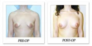 phoca_thumb_l_hodnett-breast-augmentation-patient4-front