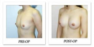 phoca_thumb_l_hodnett-breast-augmentation-patient7-oblique