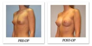 phoca_thumb_l_hsu-breast-augmentation-005