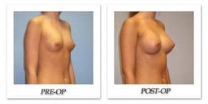 phoca_thumb_l_hsu-breast-augmentation-006