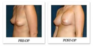 phoca_thumb_l_hsu-breast-augmentation-008