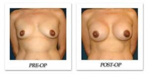 phoca_thumb_l_hsu-breast-augmentation-010