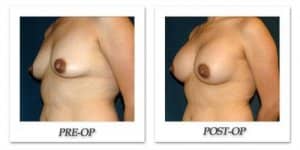 phoca_thumb_l_hsu-breast-augmentation-011