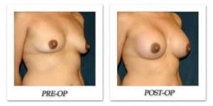phoca_thumb_l_hsu-breast-augmentation-013