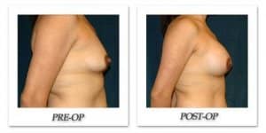 phoca_thumb_l_hsu-breast-augmentation-014