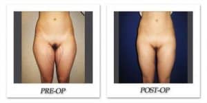 phoca_thumb_l_cohen-liposuction-008