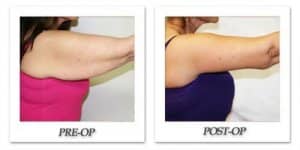 phoca_thumb_l_dr-begovic-arm-lift-before-after-001