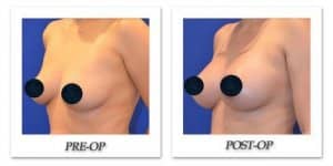 phoca_thumb_l_breast-augmentation-1