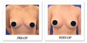 phoca_thumb_l_breast-augmentation-2