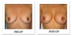 phoca_thumb_l_bruno-breast-augmentation-007