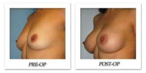 phoca_thumb_l_bruno-breast-augmentation-008