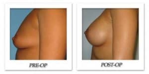 phoca_thumb_l_bruno-breast-augmentation-014