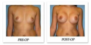 phoca_thumb_l_bruno-breast-augmentation-017