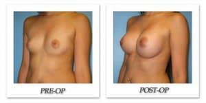 phoca_thumb_l_bruno-breast-augmentation-018