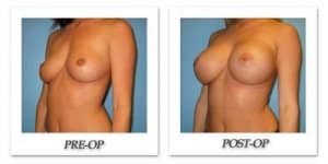 phoca_thumb_l_bruno-breast-augmentation-024