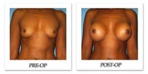 phoca_thumb_l_bruno-breast-augmentation-026