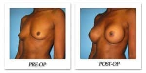 phoca_thumb_l_bruno-breast-augmentation-027