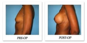 phoca_thumb_l_bruno-breast-augmentation-028