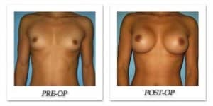 phoca_thumb_l_bruno-breast-augmentation-029
