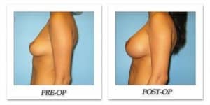 phoca_thumb_l_bruno-breast-augmentation-042