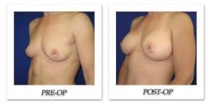 phoca_thumb_l_cohen-breast-augmentation-002