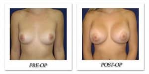 phoca_thumb_l_cohen-breast-augmentation-005