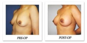 phoca_thumb_l_cohen-breast-augmentation-008