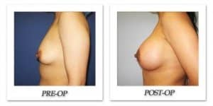 phoca_thumb_l_cohen-breast-augmentation-009
