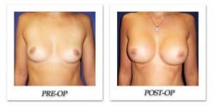 phoca_thumb_l_cohen-breast-augmentation-013