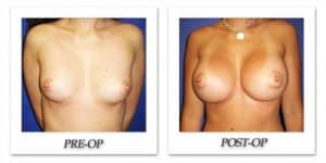 phoca_thumb_l_cohen-breast-augmentation-015