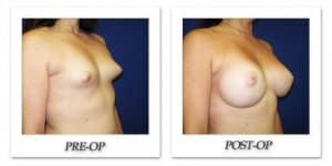 phoca_thumb_l_cohen-breast-augmentation-024