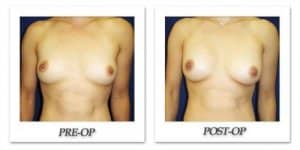 phoca_thumb_l_cohen-breast-augmentation-029
