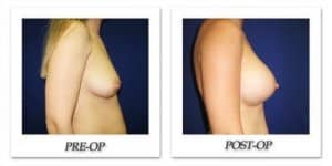 phoca_thumb_l_cohen-breast-augmentation-036
