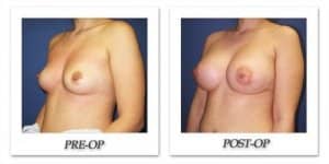 phoca_thumb_l_cohen-breast-augmentation-038
