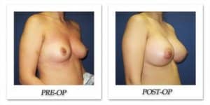 phoca_thumb_l_cohen-breast-augmentation-039