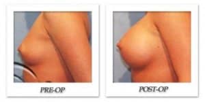 phoca_thumb_l_hodnett-breast-augmentation-001
