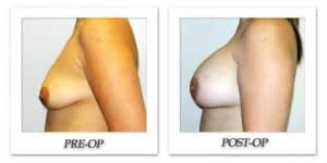 phoca_thumb_l_hodnett-breast-augmentation-019