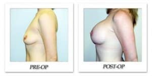 phoca_thumb_l_hodnett-breast-augmentation-023