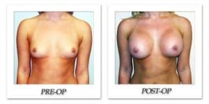 phoca_thumb_l_hodnett-breast-augmentation-030
