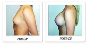 phoca_thumb_l_hodnett-breast-augmentation-031