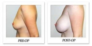 phoca_thumb_l_hodnett-breast-augmentation-038