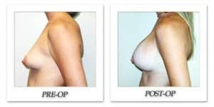 phoca_thumb_l_hodnett-breast-augmentation-059