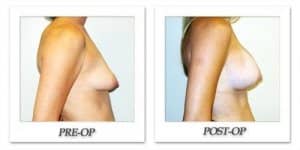 phoca_thumb_l_hodnett-breast-augmentation-060