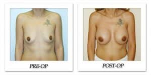 phoca_thumb_l_hodnett-breast-augmentation-patient1-front