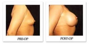 phoca_thumb_l_hodnett-breast-augmentation-patient10-side