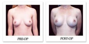 phoca_thumb_l_hodnett-breast-augmentation-patient11-front