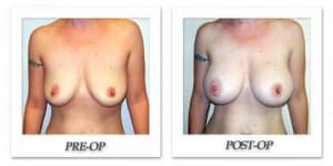 phoca_thumb_l_hodnett-breast-augmentation-patient13-front