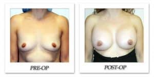 phoca_thumb_l_hodnett-breast-augmentation-patient2-front