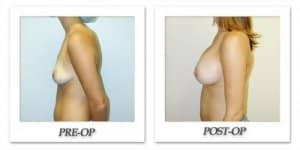 phoca_thumb_l_hodnett-breast-augmentation-patient8-side