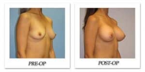 phoca_thumb_l_hsu-breast-augmentation-003